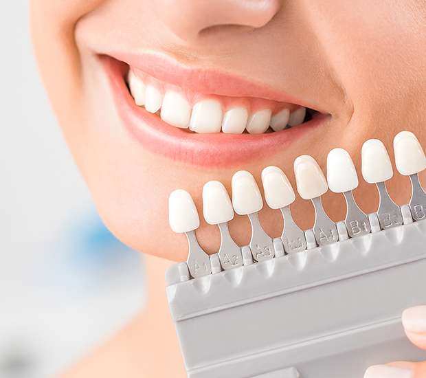 Williamsburg Dental Veneers and Dental Laminates